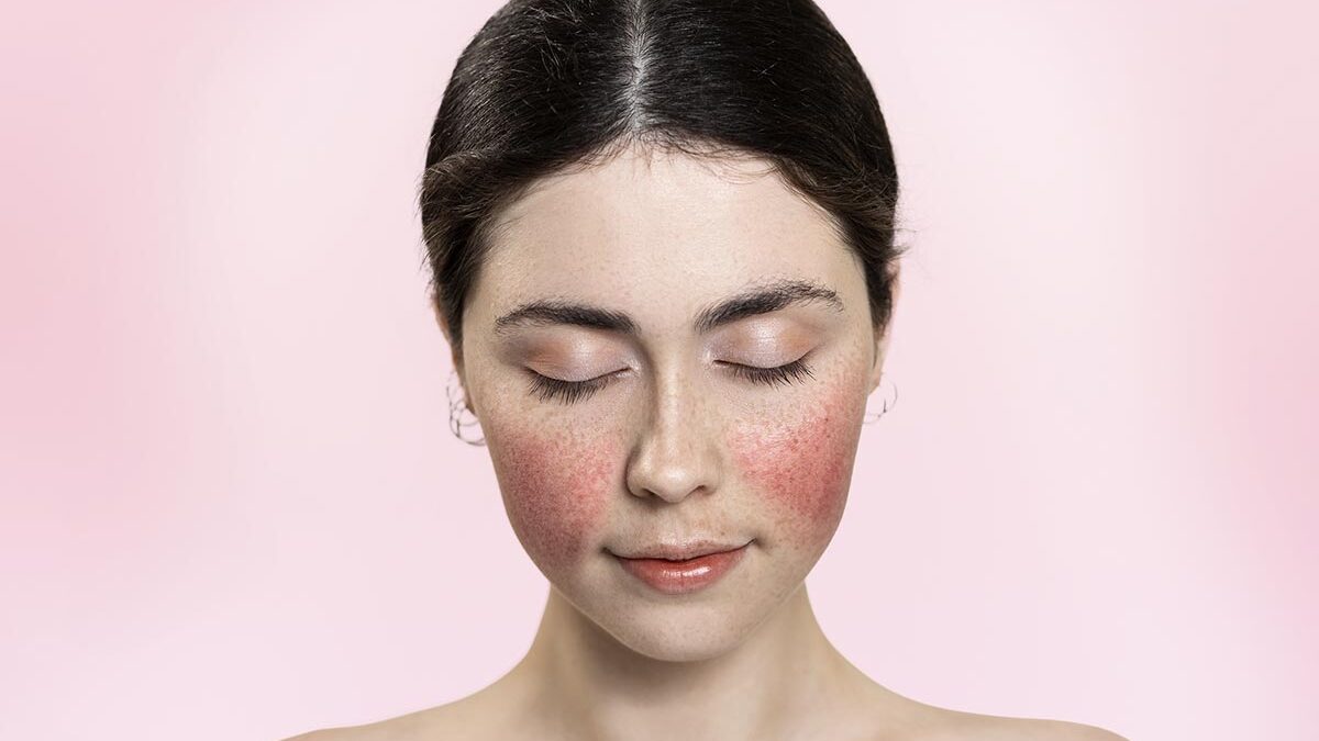 Retrato de uma mulher com os olhos fechados, mostrando vasos sanguíneos inflamados