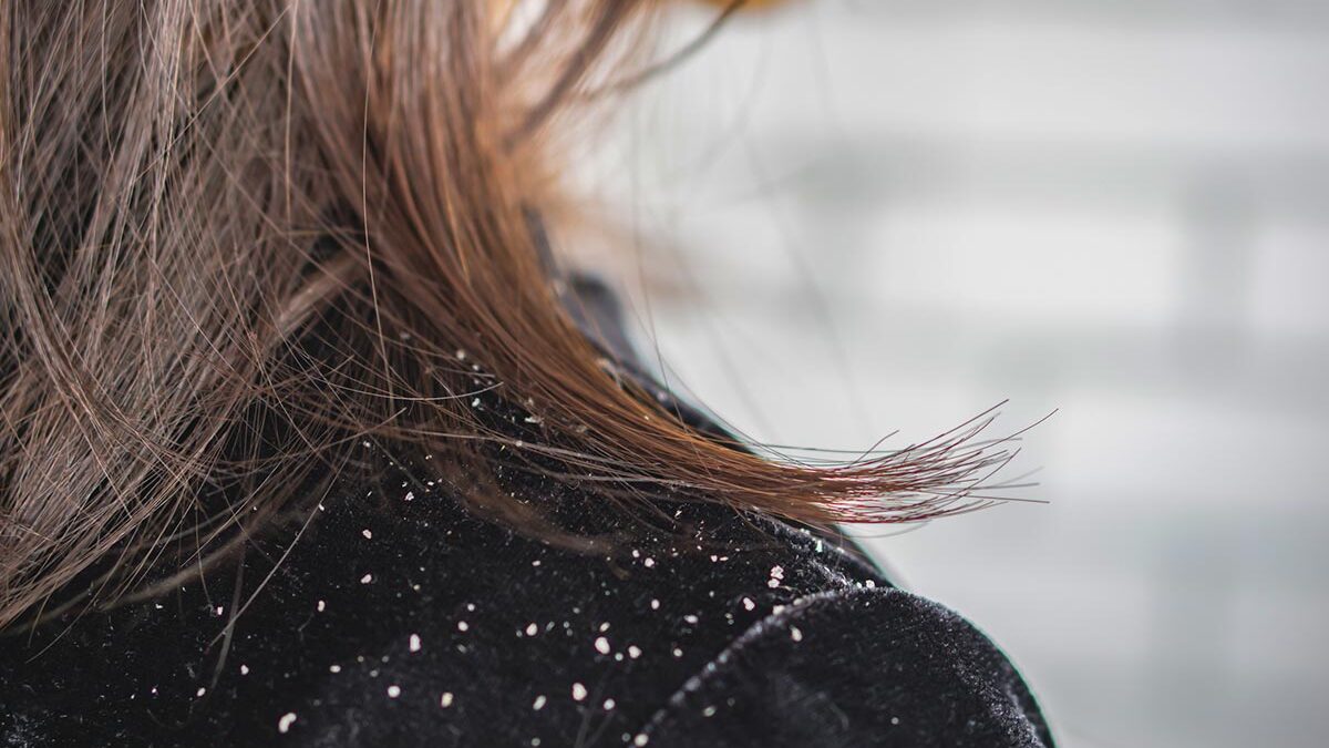 Cabelo de mulher com caspa caindo sobre os ombros