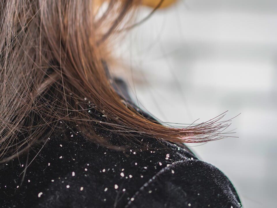 Cabelo de mulher com caspa caindo sobre os ombros