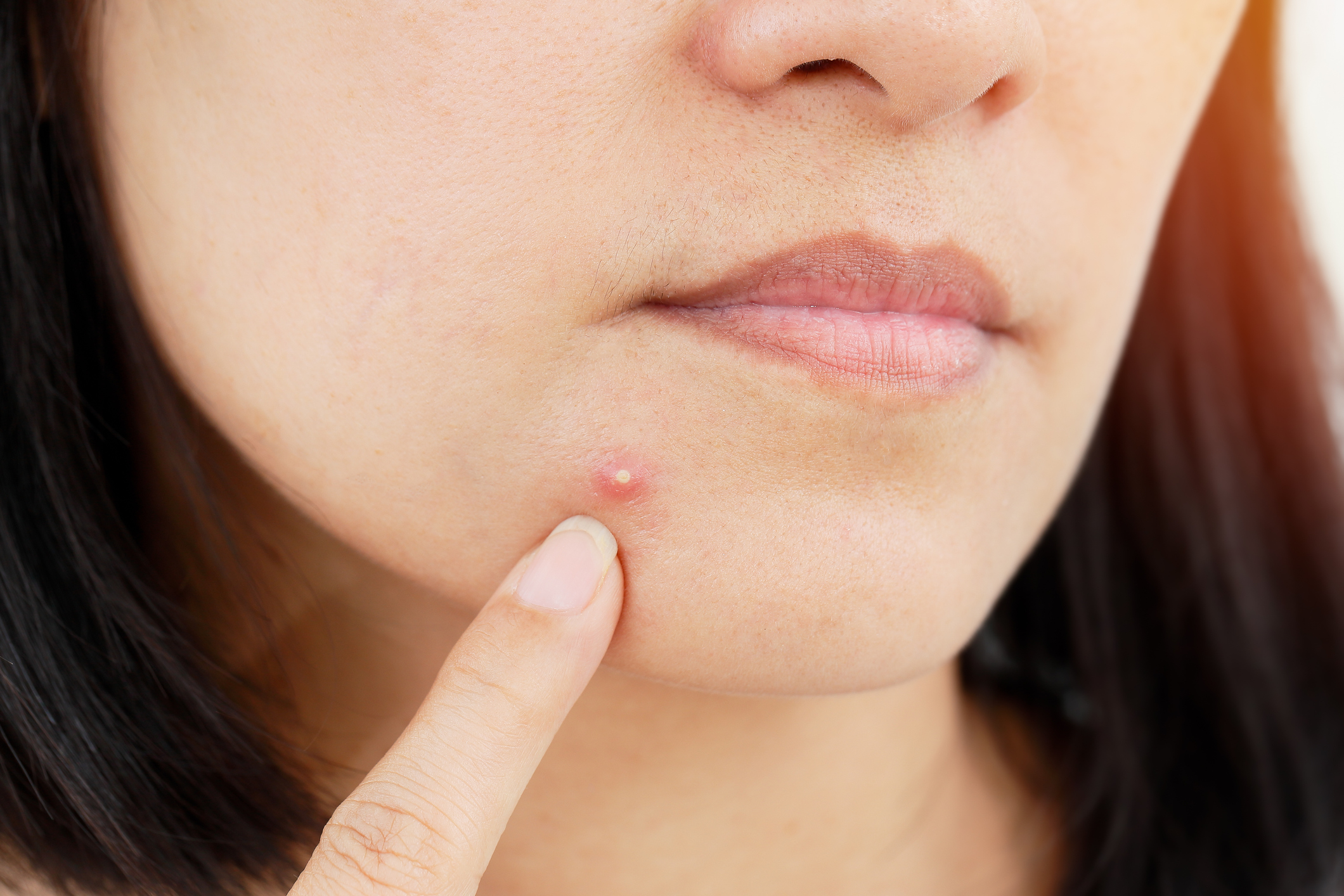 Confira como agir quando a acne gera um caroço no rosto