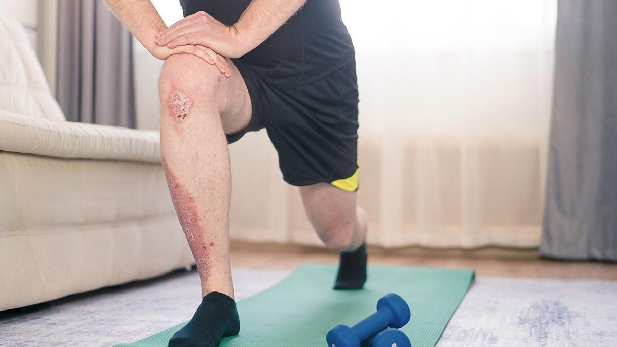 homem com Psoríase praticando exercício