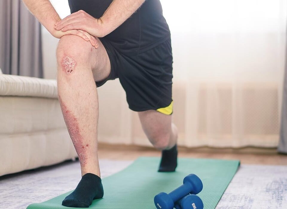 homem com Psoríase praticando exercício