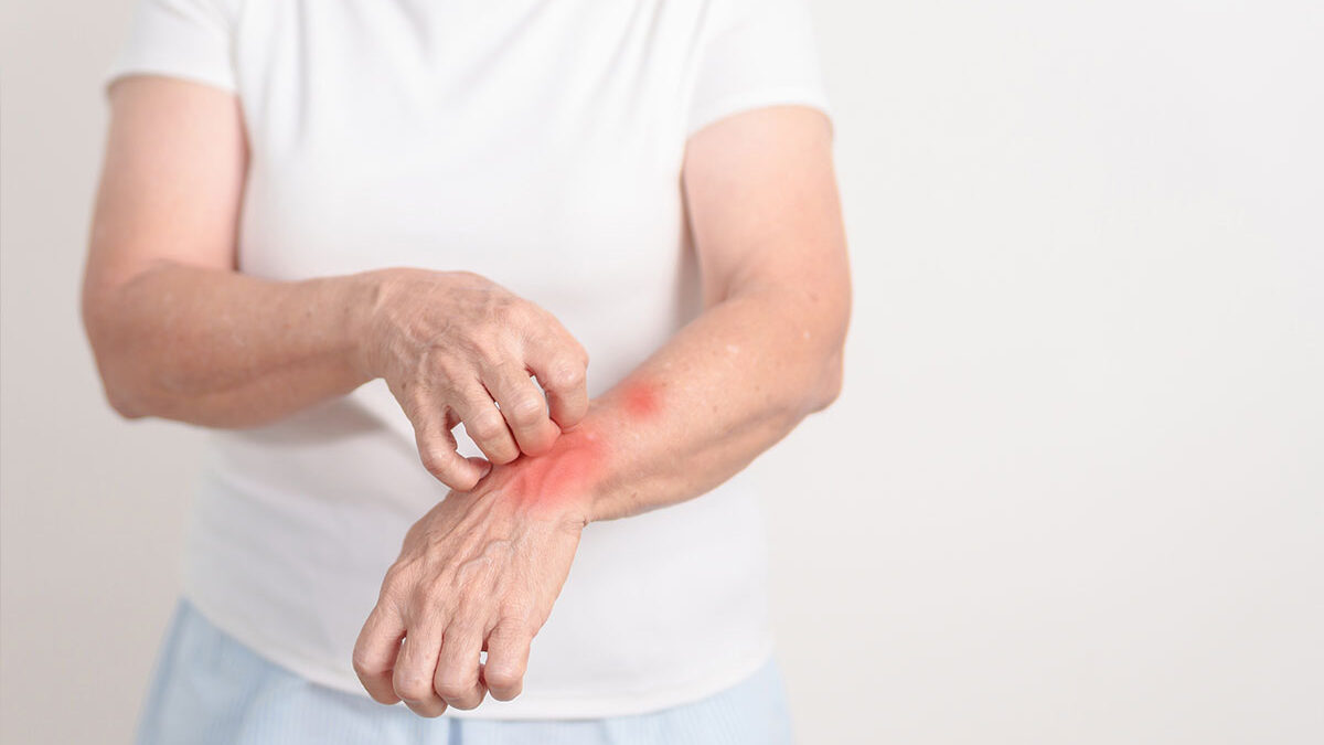 Mulher com coceira devido a hanseniase