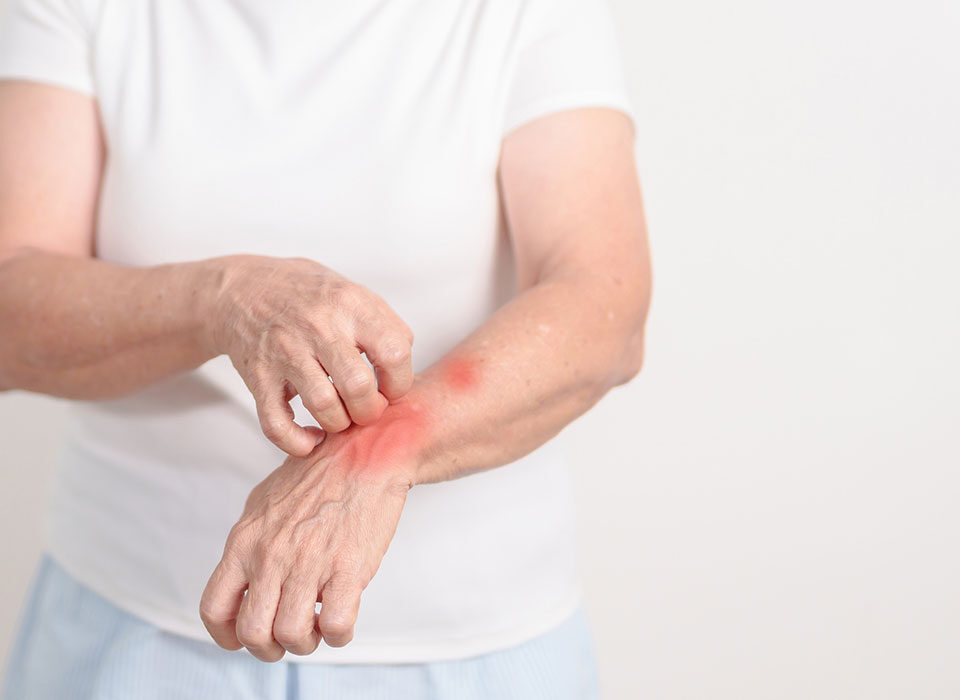 Mulher com coceira devido a hanseniase